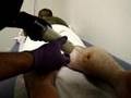 Compartment Syndrome Pressure Gauge