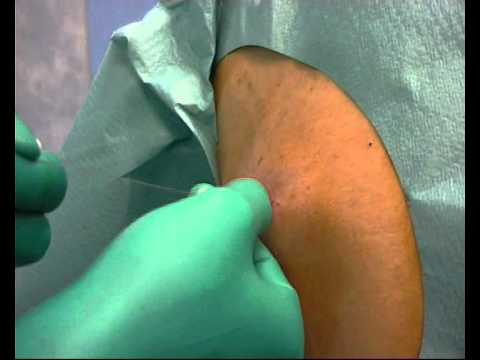 how to drain liver abscess