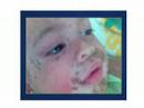 videos de Staphylococcal Scalded Skin Syndrom