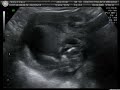 Em breve mais um lindo bebe no mundo!