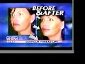 Dr. Scott Miller on KUSI 51 News: Contour Thread Lift Dr. Scott Miller on KUSI 51 News: Contour Thread Lift