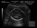 2� ecografia do nosso Beb�