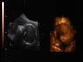 3D Baby Ultrasound