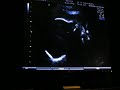 Baby Lima Bean at 30 weeks