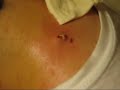 Cyst Extraction
