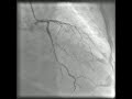Angeo video - Please help  Procedures and Therapies Heart Bypass Surgery