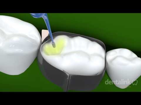 La Ortodoncia Con Aparatos Fijos