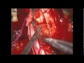 EPENDIMOMA CERVICAL.mpg