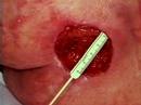 Caring for Pressure Ulcers pt 2 of 4 Caring for Pressure Ulcers pt 2 of 4