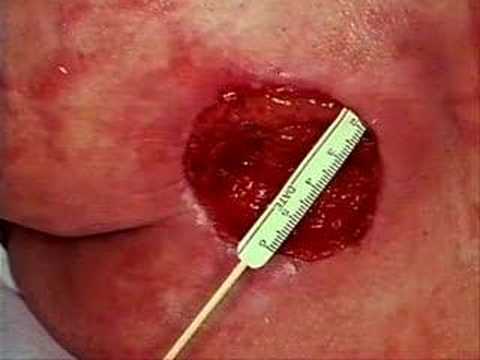 how to cure bed sores
