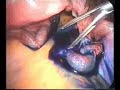 laparoscopic genital adhesyolysis