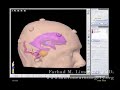 Vestibular Schwannoma Neurosurgical Removal