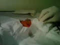 Cyst Removal from Arm