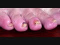Lyme Disease in Europe