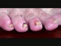 Lyme Disease in Europe