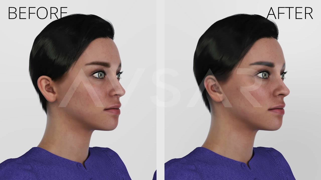 Ear Surgery Otoplasty 3D Surgery in Istanbul Turkey by Dr. Yakup Avsar
