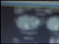 CT-Scan-Cancer-non-h