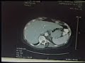 CT Scan Cancer non-hodgekins lymphoma  Cancer Bile Duct Cancer