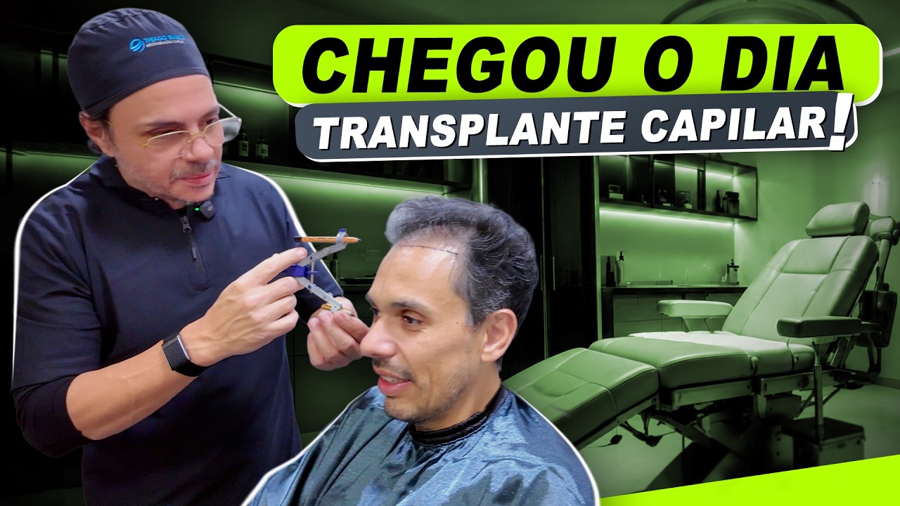Fiz um TRANSPLANTE CAPILAR e NINGUÉM PERCEBEU (sem raspar o cabelo) #macmasi #institutothiagobianco