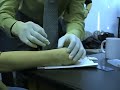 Ganglion Cyst Removal with Acupuncture