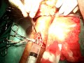 arteriovenous fistula; aneurysm