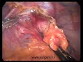 Esophageal hernia laparoscopic Nissen procedure. Part 1.