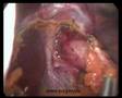 Esophageal hernia laparoscopic Nissen procedure. Part 1.