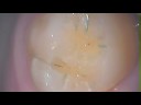 undiagnosed decay found by laser