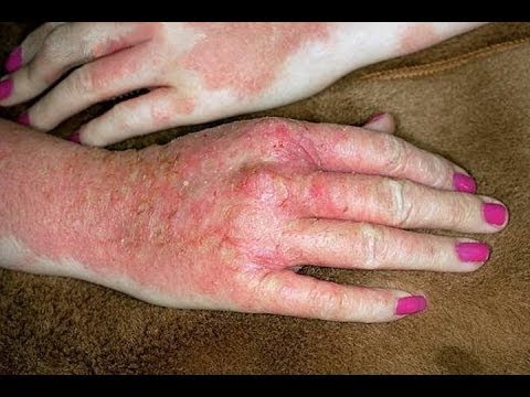 how to get rid of eczema and eczema scars