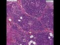 Histopathology Pancreas --Islet cell tumor (insulinoma)