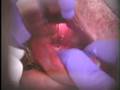 Epiglottis Camouflage