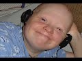 Down syndrome:&nbsp;Down Syndrome: Santa is Coming to Town