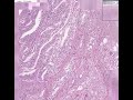 Histopathology Prostate--Adenocarcinoma (Gleason grade 4)