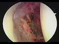 Hip Labral Tear Debridement  Impingement Correction