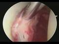 Hip Labral Tear Debridement & Impingement Correction