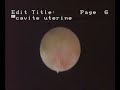 hysteroscopic-aspect-of-female-genital-tuberculosis.html