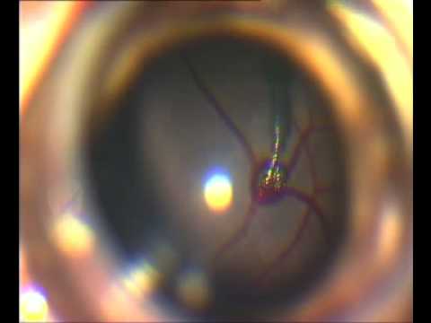 of retinal vein occlusion.