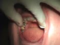Tissue Management for before Prosthetic procedures