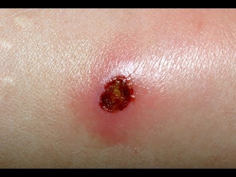 how to treat mrsa infection