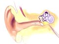 PreOp® Patient Education Myringotomy Insertion of Tube 3