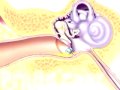 preop® Patient Education Myringotomy Insertion of Tube 3