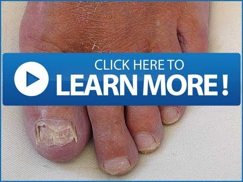 how to treat onychomycosis