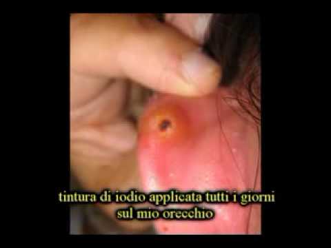 how to kill ear fungus