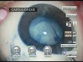 Cirurgia de Facoemulsificação Cirurgia de Facoemulsificação