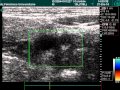 Internal Carotid Artery Occlusion In Ultrasound Exam Internal Carotid Artery Occlusion In Ultrasound Exam