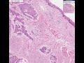 Histopathology Tongue--Squamous cell carcinoma