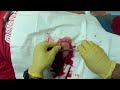 Dr. Oller walksthrough the treatment and repair of this abdominal laceration