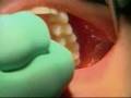 Teeth Grinding - NJN News Healthwatch Report