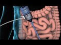 Inguinal Hernia Surgery Repair