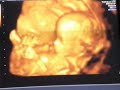 OUR LITTLE GIRL 13 WEEK SCAN OUR LITTLE GIRL 13 WEEK SCAN